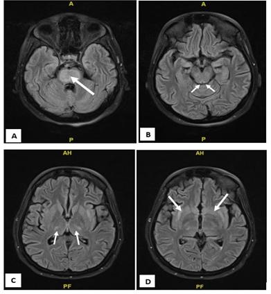 Figure 1: T2 heterogenous predominantly hyperintense area noted involving A. the central regions of pons. B. midbrain – tegmentum and tectum. C. Bilateral Thalami-Ventrolateral Regions and D. External Capsule with İnvolvement of Adjacent Lentiform Nucleus. There is evidence of diffusion restriction noted in these areas. No evidence of blooming in T2 sequences.