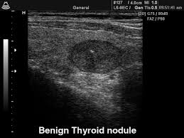Figure 1: ** Benign nodule in USG**.**