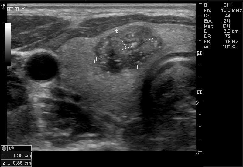 Figure 2: ** Malignant nodule in USG. USG features of thyroid nodule [6].
