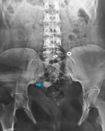 Figure 1: Abdomen Xray showing radio-opaque calculi.