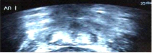 Figure 1: Ultrasound report urinary bladder wall was 7.7mm sonic shadow after fungoma of 2.15x1.16x 0.46cms.