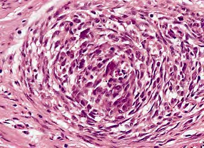 Figure 1: Plexiform fibrohistiocytic tumour constituted of nodules histiocyte-like cells, giant cells, fibroblastic cells, fibro-histiocytic cells, enmeshed within a fibro-collagenous stroma [9].