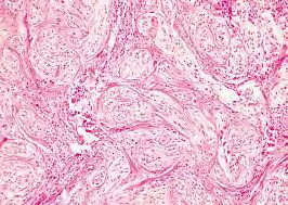 Figure 2: Plexiform fibrohistiocytic tumour delineating aggregates of histiocytoid cells, fibroblastic and fibro- histiocytic cells with an enveloping collagenous stroma and a superimposed epidermal layer [9].