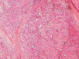 Figure 3: Plexiform fibrohistiocytic tumour depicting nodules of histiocytoid cells, few giant cells, fibroblastic and fibro-histiocytic cells intermixed within a fibrotic stroma [10].