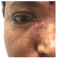 Figure 1: Swelling around right eye.