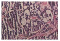 Figure 3: Facial artery and Facial vein.