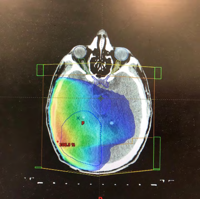 Figure 1: Isodose distribution of PTV with 3D-CRT.