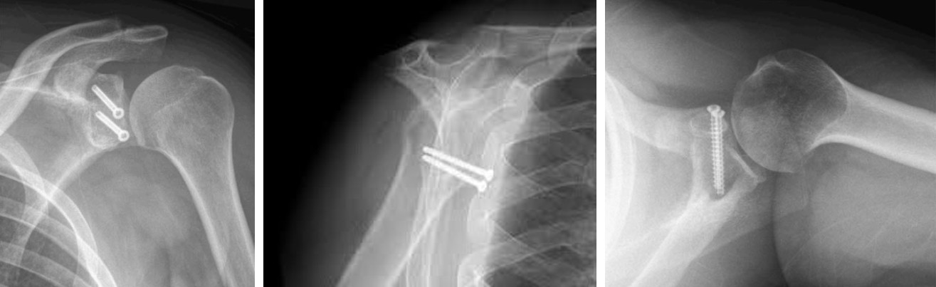 Figure 1: X-rays of the Latarjet Procedure.