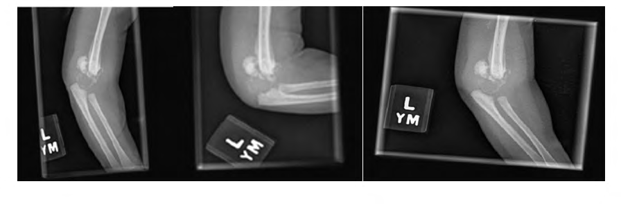 Figure 1: Anteriorposterior (AP), lateral and oblique radiographs taken two weeks after birth. Radiographs reveal a left elbow physeal separation with significant callus formation.