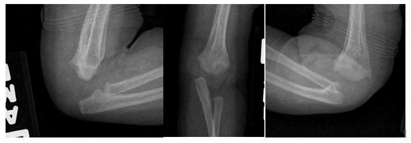 Figure 3: Orthogonal images demonstrate near normal anatomic alignment at the 2 month visit.