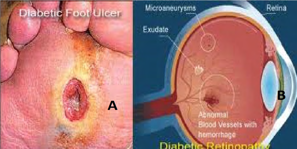 Figure 1: A: Diabetic Foot Ulcer. B: Diabetic Retinopathy.