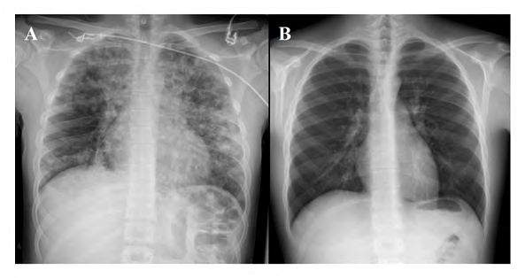Figure 1: Patient 1. A) Chest-X-ray performed in Emergency Room. B) Chest X-ray before discharge.
