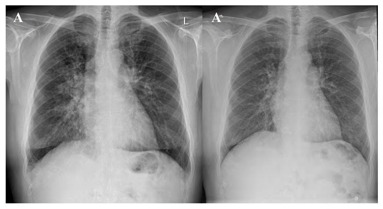 Figure 3: Patient 2. A) Chest-X-ray performed in ICU. B) Chest X-ray performed before discharge.