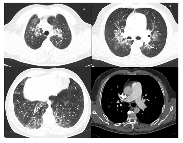 Figure 4: Patient 2. A), B), C): bilateral parenchymal opacities and “ground-glass” thickenings. D): increase of pulmonary artery caliber.