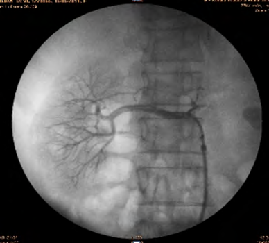 Figure 3: Post Angioplasty of right renal artery.