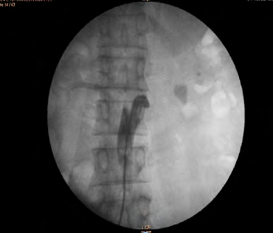 Figure 4: Renal angiography showing complete occlusion of left renal artery.