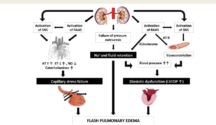 Figure 5: The Pickering Syndrome. Three main pathophysiological mechanisms contribute to the development of flash pulmonary edema defective pressure natriuresis with sodium and fluid retention, increased left ventricular end-diastolic pressure associated with left ventricular hypertrophy and stiffening, and failure of the pulmonary capillary blood-gas barrier. RAAS: Renin- Angiotensin-Aldosterone System; SNS: Sympathetic Nervous System; Na+: Sodium; AII: Angiotensin II; ET-1: Endothelin-1; NO: Nitric Oxide.