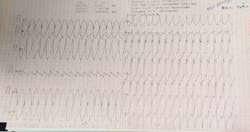 Figure 1: ECG Showing Ventricular Arrhythmia Reverted to Sinus Rhythm After Defibrillation.