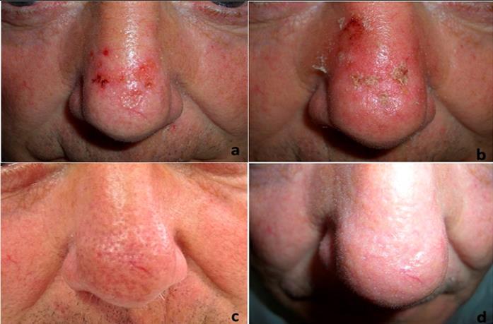 Figure 1: Patient 7. a. Pre-treatment. b. Day 4: Mild local skin reaction. c. Day 60: Complete clearance. d. Day 365: Sustained clearance.