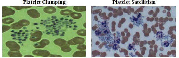 Figure 11: Picture of thrombocytosis and essential thrombocythaemia.