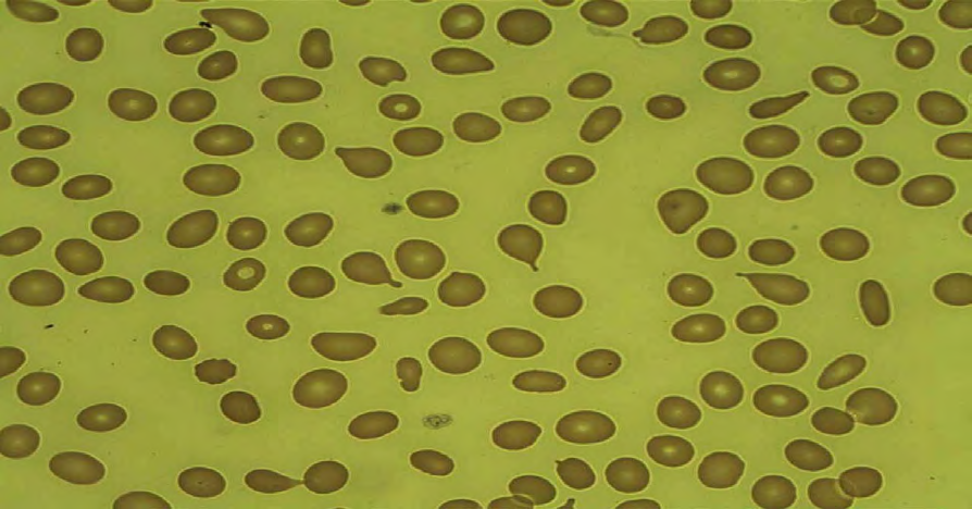Figure 4: Blood film showing normal red cells.