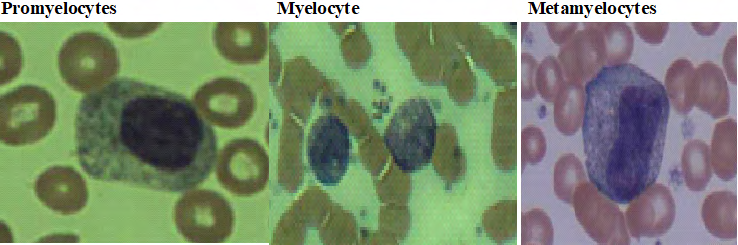 Figure 5: Blood Picture of a promyelocyte, myelocyte and metamyelocytes.
