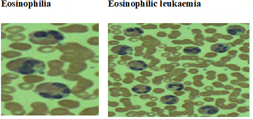 Figure 7: Picture showing Eosinophilia and Eosinophilic Leukaemia.