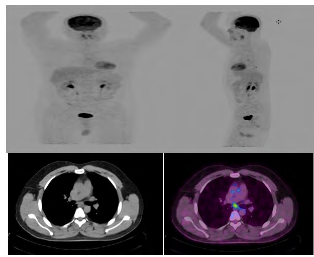 Figure 2: Maximum Intensity Projection (MIP) view shows focal hypermetabolic area in the brain. There is a subcentimetrichypermetabolic (SUVmax 4.3) sub-carinal lymph node.