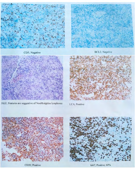 Figure 3: Shows Histopathology and Immunohistochemistry of primary CNS Non-Hodgkins lymphoma.