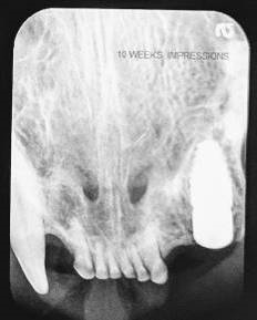 Figure 11: Clinical appearance at 10 weeks post-surgical demonstrating healthy non-inflamed gingival tissue around the healing abutment.