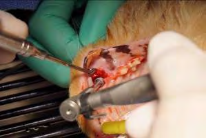 Figure 6: Osseous graft material is placed into the gap between the implant and wall of the extraction socket prior to flap closure.