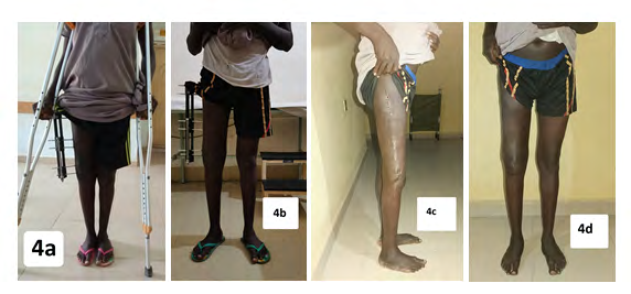 Figure 4: (a) The ambulant patient with LRS on his right femur. (b) Walking unaided before removal of the LRS (c, d) After removal of LRS.