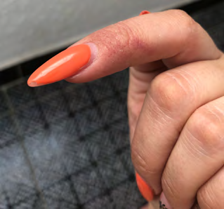 Figure 2: Eccematous dermatitis in the second finger of left hand. Here she wears gel nails.