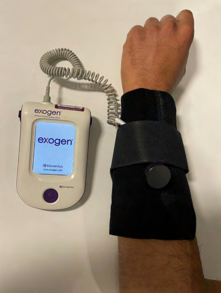 Figure 3: Illustrative example of ExoGen application for a forearm fracture.
