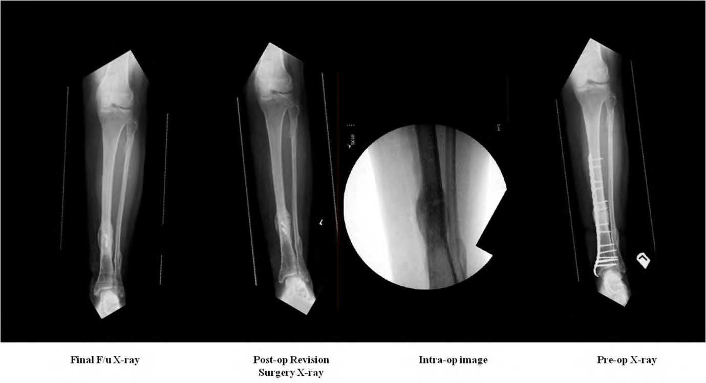 Figure 6: AP & Lateral radiographs illustrating excellent union achieved by revision surgery following failure with extended use ExoGen.