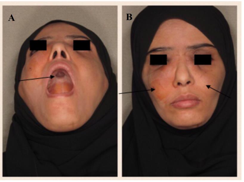 Figure 1: (A) Central hard palate lesion. (B) Swelling over both sides of the cheeks and lateral nasal surfaces.