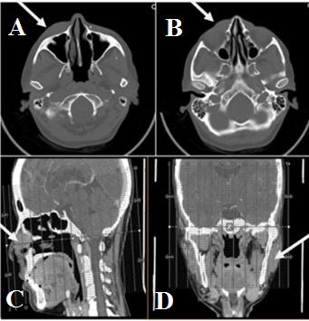 Figure 2: Nonenhanced and enhanced CT of the facial bone were performed with sagittal and coronal reformations in soft tissue and bone windows. A,B: Skin thickening with abnormal enhancing soft tissue involving the cheek, nose and medial periorbital region C: Minimal mucosal thickening of the right maxillary sinus and ethmoid air cells D: Benign intraparotid lymph nodal enlargement.