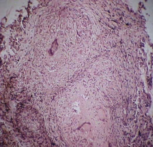 Figure 4: Vascular ring in 4-month-old boy. Wheezing, dyspnea, tachypnea from birth. Inspiratory RF. Successfully operated - elimination of the vascular ring. Figure 4a: Bronchofibroscopy: constriction of the trachea. Deformation of the middle and lower third of the trachea due to external compression.