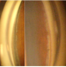 Figure 3: Wide ciliary body band seen on gonioscopy.