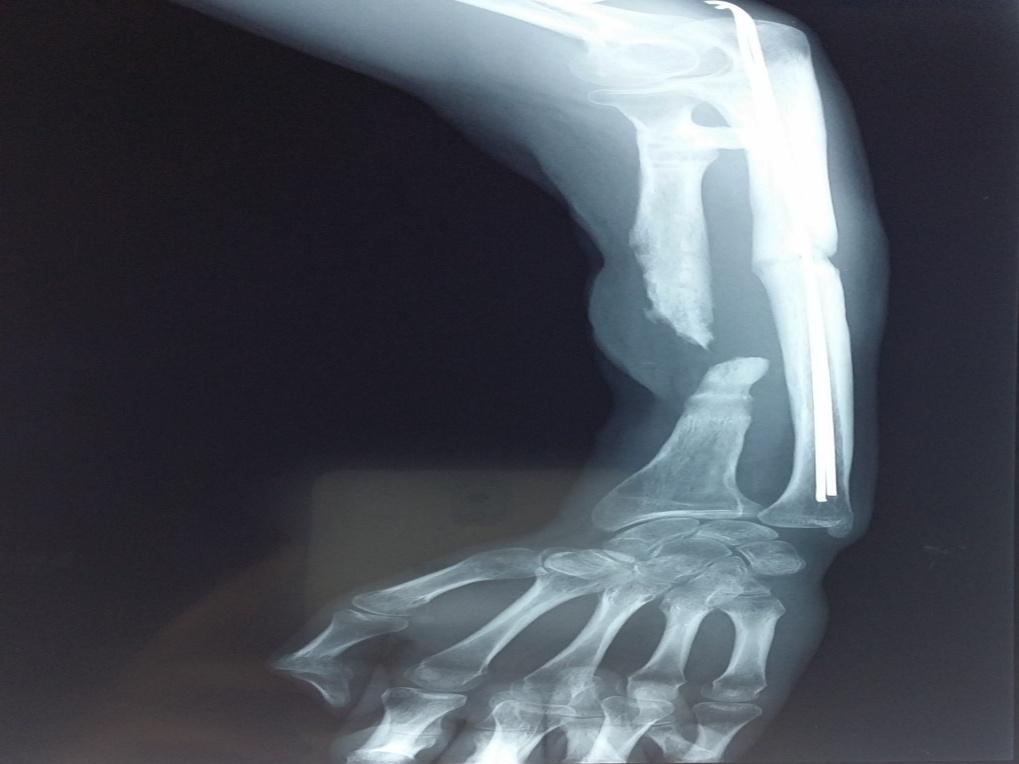 Figure 2: Non-union of the radius with radio ulnar synostosis after 1year.