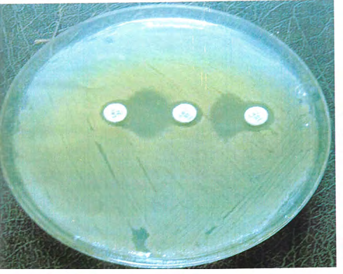 Figure 5: Dump bell inhibition zone of positive double disk synergy test (DDST) characteristics of ESBL producing Proteus.