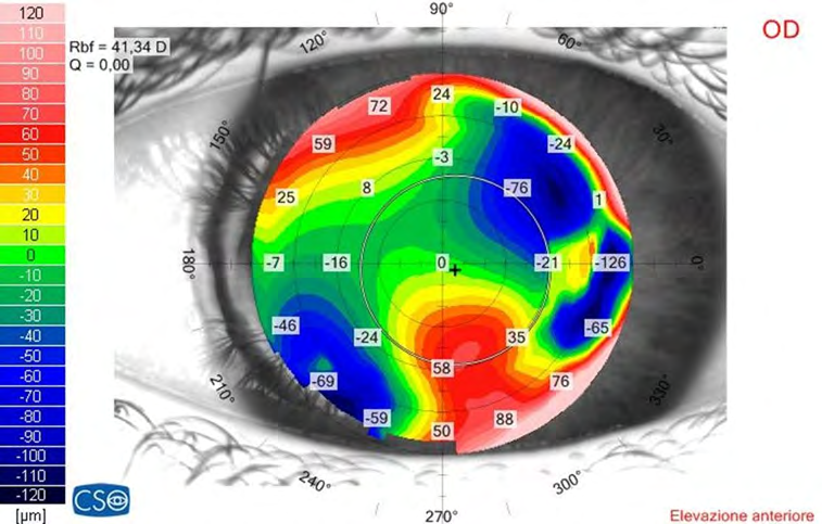 Figure 1: The right eye anterior elevation map (Sirius scheimplflug camera, CSO, Italy) performed before femtosecond laser treatment shows the inferior steepen area corresponding to the corneal scar.
