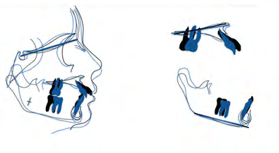 Figure 4: Post activator dento-alveolar changes.