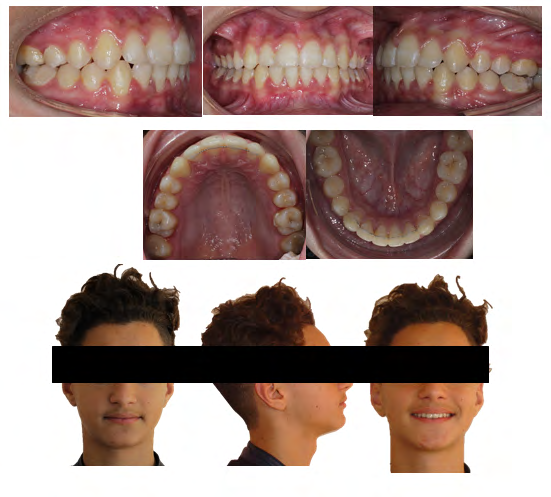 Figure 6: Superimpositions before and after using the activator.