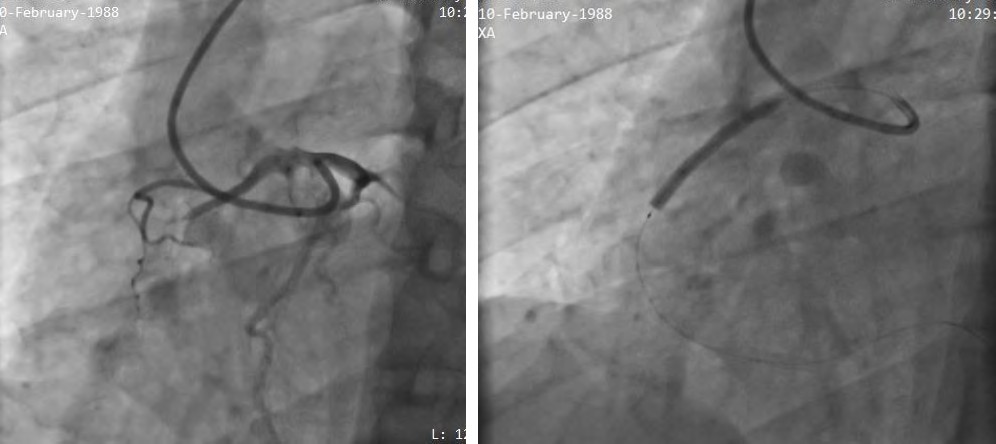 Figure 1: Diagnostic Angiogram Done with JL 3.0 from Right Radial Route Showing Total Occluded Anomalous Origin of RCA From Left Coronary Sinus and Subsequent Stenting Done.