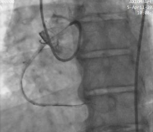 Figure 2: Right Femoral Angiogram Showing Anomalous RCA Origin from Left Sinus with JL 3.0 Guiding Catheters and Subsequent Angioplasty.