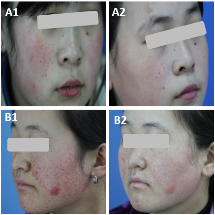 Figure 1: Two female patients with numerous FA. Side facial views of the patient before (A1, A2) and 6 month later (B1, B2) after laser treatment showing a satisfactory aesthetic result.
