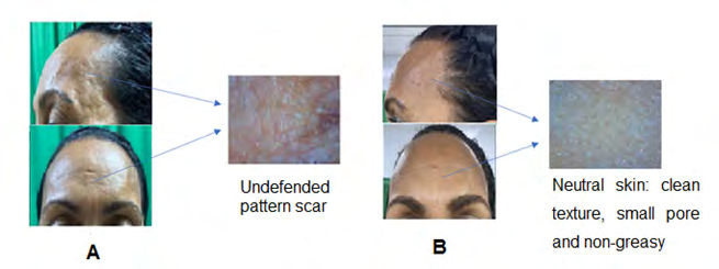 Figure 1: A. Preoperative: Female patient with a left superciliary post-traumatic scar of 3cm in length, depressed and adhered to deep planes associated with sign of aging. B. Postoperative: Little visible scar, with a filing effect that made it flat and uniform. In addition, reduction of wrinkles and depth of furrows, disappearance of marionette lines, smooth, resistant and flexible skin.