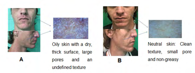 Figure 2: A. Preoperative: Male patient with atrophic scars, sunken like ice pick after facial acne conglobate. B. Postoperative: Scars attenuation, texture improvement, younger skin, increased luminosity and hydration.