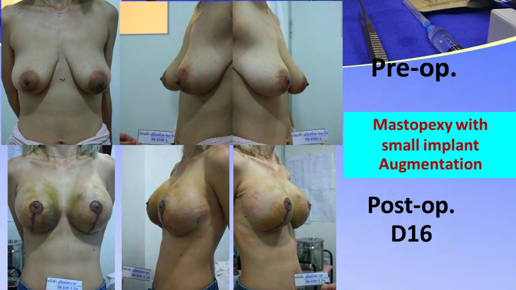 Figure 4: Patient with severe ptosis, and small volume is managed by mastopexy with small breast implant augmentation. This case use 325 cc of high profile implant. Pictures show preoperatively, sixteenth day postoperatively. Both breasts has postoperative bruise. Bruise is temporary and complete recovery within three to four weeks.